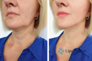 Double chin before and after Hi-Fu treatment 4 Book your double chin treatment Reigate today! We are here to help!