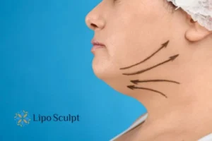 Double chin before and after Hi-Fu treatment 3 Boost your confidence with a Double chin treatment Reigate