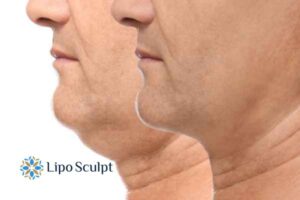 Double chin before and after Hi-Fu treatment 2 Double chin treatment Reigate from Lipo Sculpt - feel more confident today!