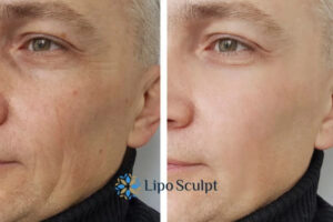 How to Fight Aging Symptoms 3 Fight Aging Symptoms Reigate With HIFU and Morpheus8 Today!