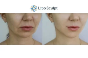 Explaining Morpheus8 And What It Can Do For You 2 Do you want to boost your self confidence? Give Morpheus8 Reigate a try today!