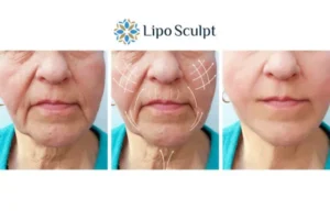 Explaining Morpheus8 And What It Can Do For You 3 Boost your confidence with Morpheus8 Reigate call our team today!