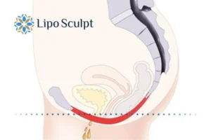 Pelvic Floor Chair Therapy 1 Pelvic Floor Chair Therapy Reigate to treat incontinence.