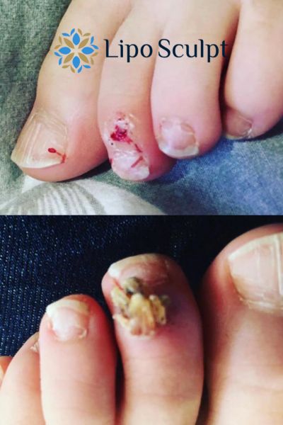 Wart removal customer results from Lipo Sculpt Reigate