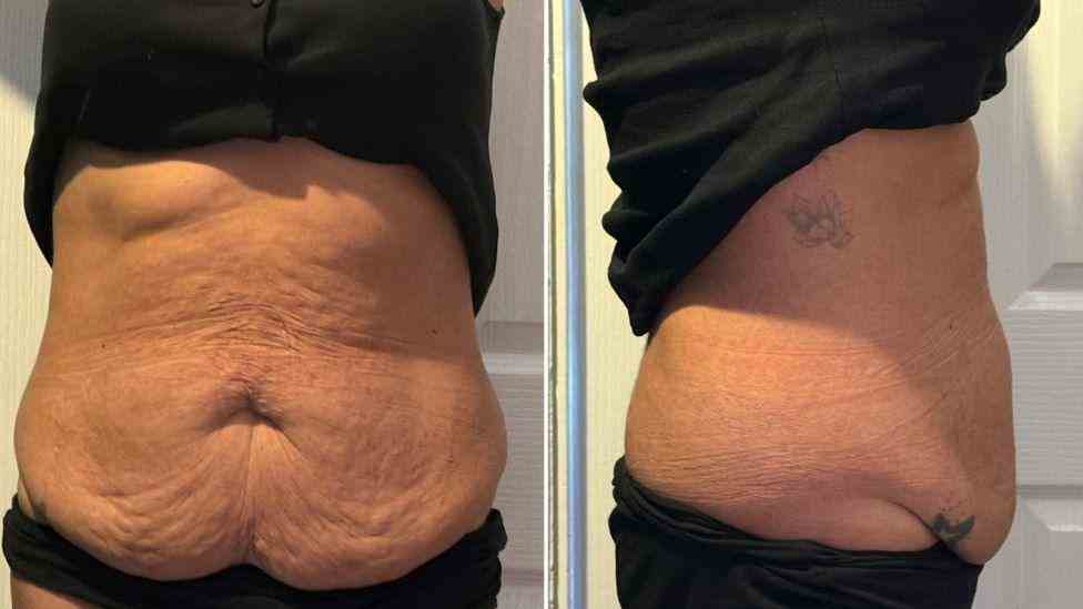 Lost the Weight but Not the Loose Skin? What You Should Know 1 Is It Definitely Loose Skin Reigate?