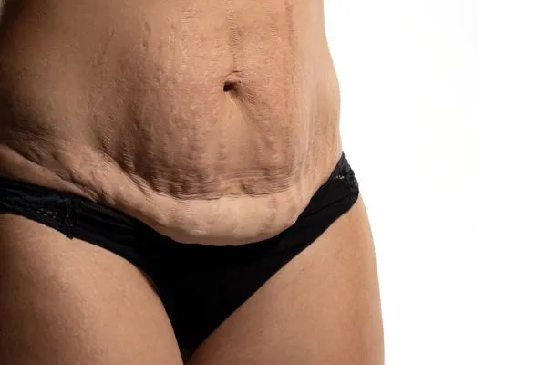 Lost the Weight but Not the Loose Skin? 1 image of womans stomach after weight loss showing loose skin Reigate