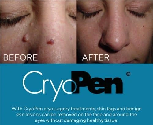 image of angiofibroma removal Reigate using Lipo Sculpt cryopen!